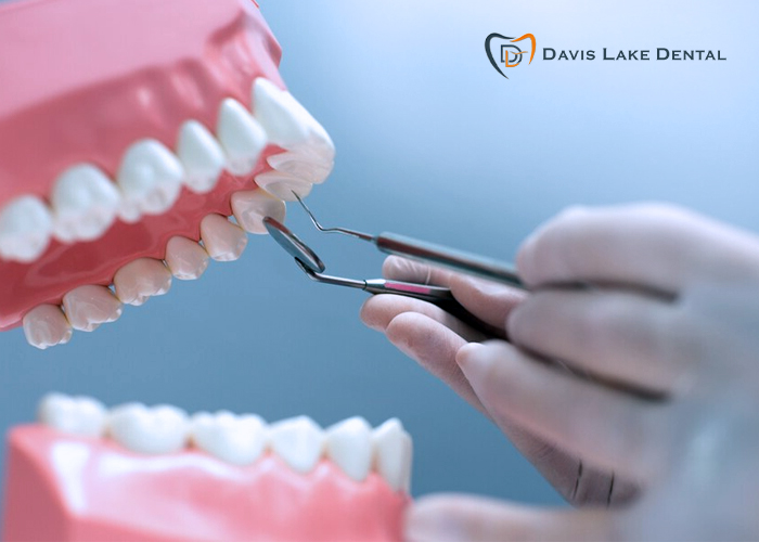 5 Things To Know Before Considering a Tooth Bridge